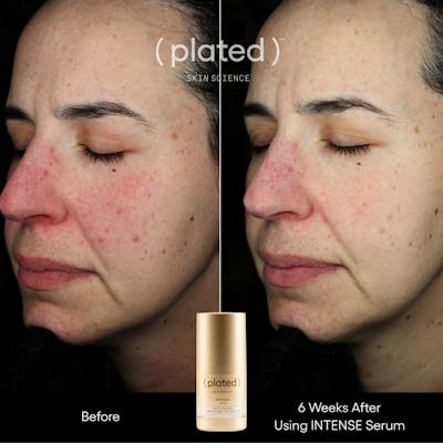 Plated™ Skincare Exosomes Before & After Gallery - Patient 338520 - Image 1