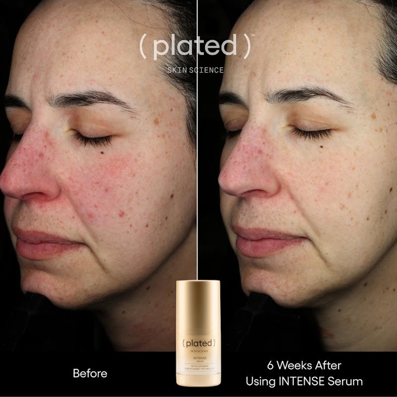 Plated™ Skincare Exosomes Before & After Gallery - Patient 338520 - Image 1