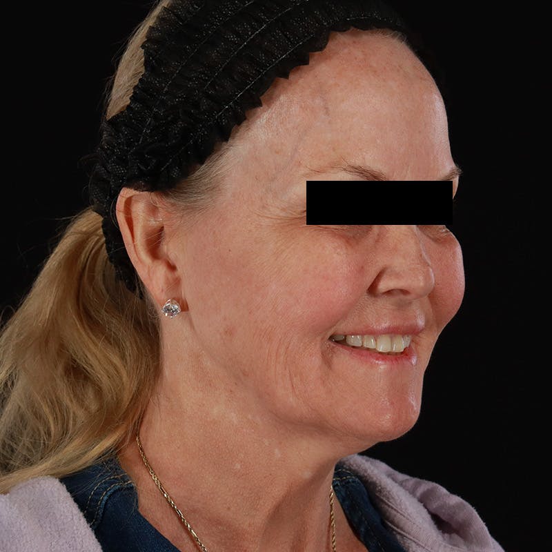 Microneedling Before & After Gallery - Patient 975502 - Image 3