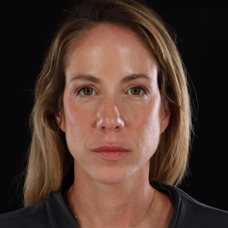 Dermal Fillers Before & After Gallery - Patient 189502 - Image 1
