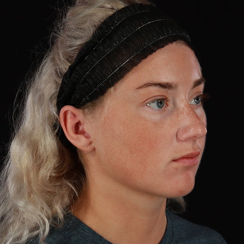 Dermal Fillers Before & After Gallery - Patient 280771 - Image 3