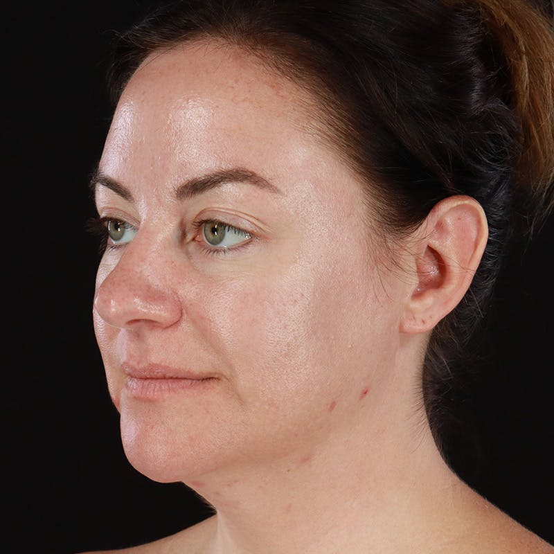 Botox Before & After Gallery - Patient 298673 - Image 7