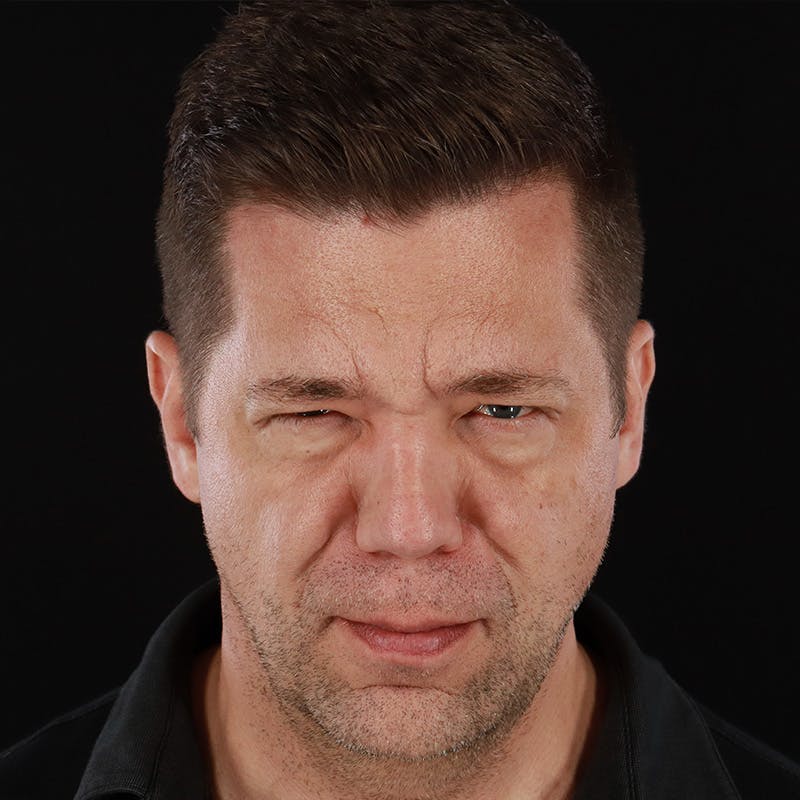 Botox Before & After Gallery - Patient 599516 - Image 4