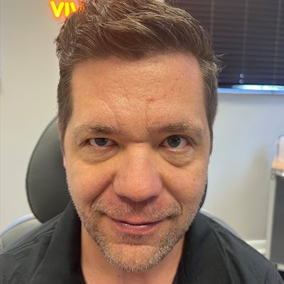 Botox Before & After Gallery - Patient 599516 - Image 1