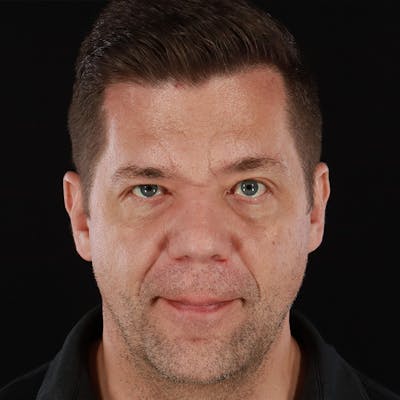 Botox Before & After Gallery - Patient 599516 - Image 2