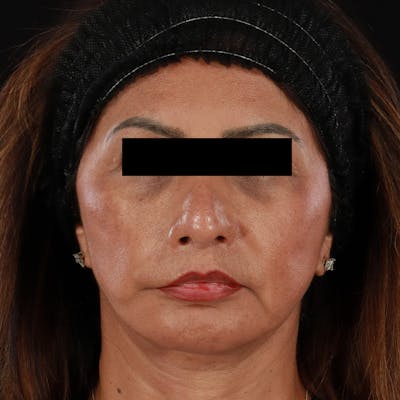 Botox Before & After Gallery - Patient 307630 - Image 1