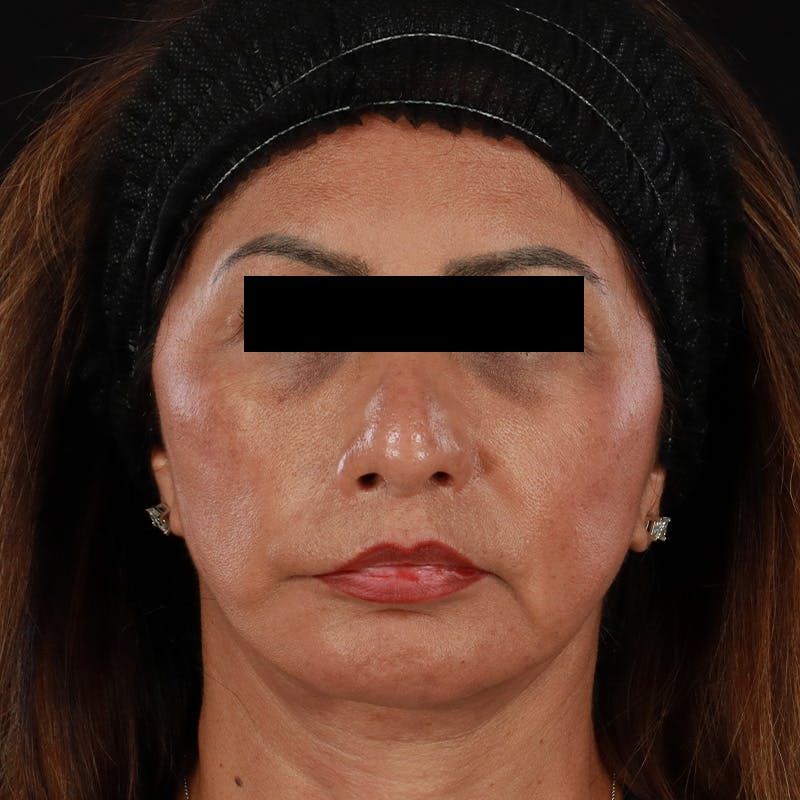 Botox Before & After Gallery - Patient 307630 - Image 1