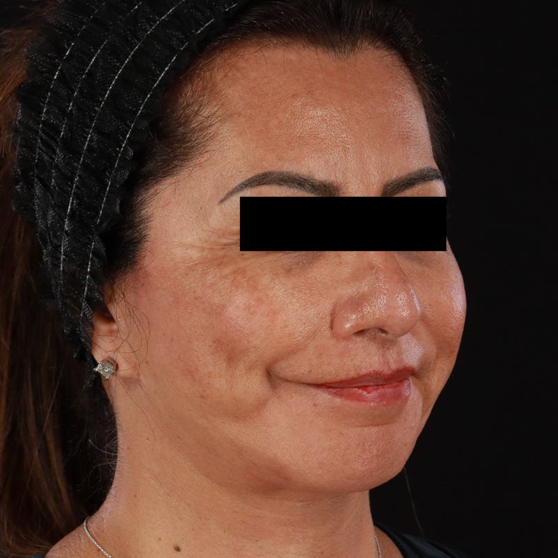 Botox Before & After Gallery - Patient 307630 - Image 6