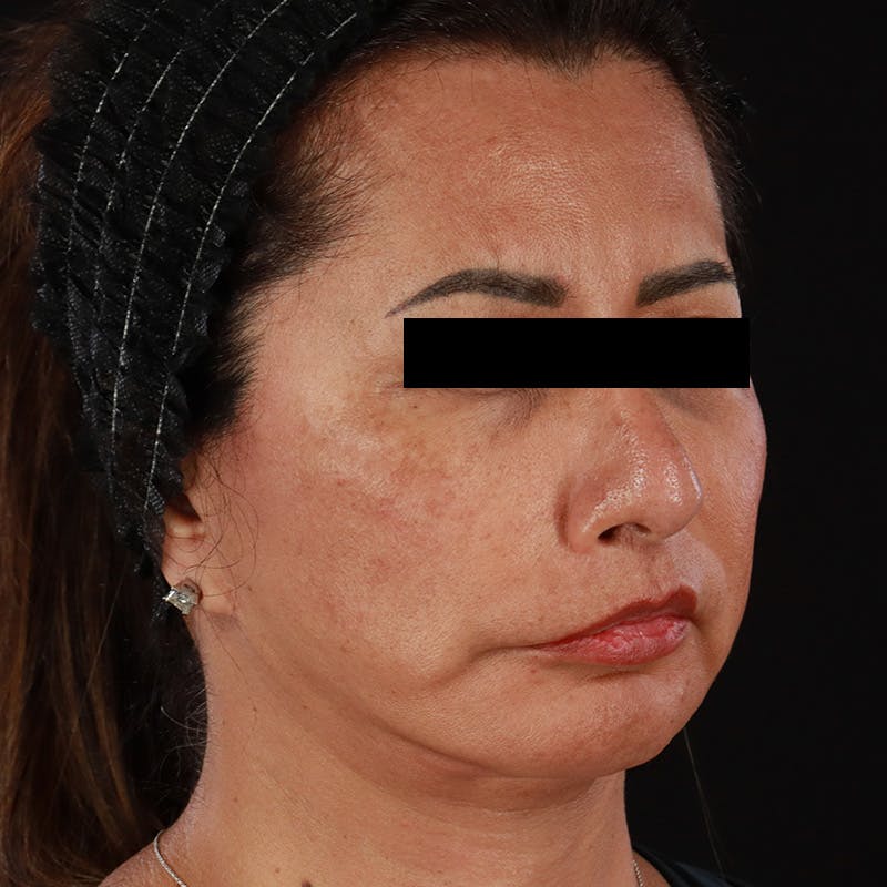 Botox Before & After Gallery - Patient 307630 - Image 10