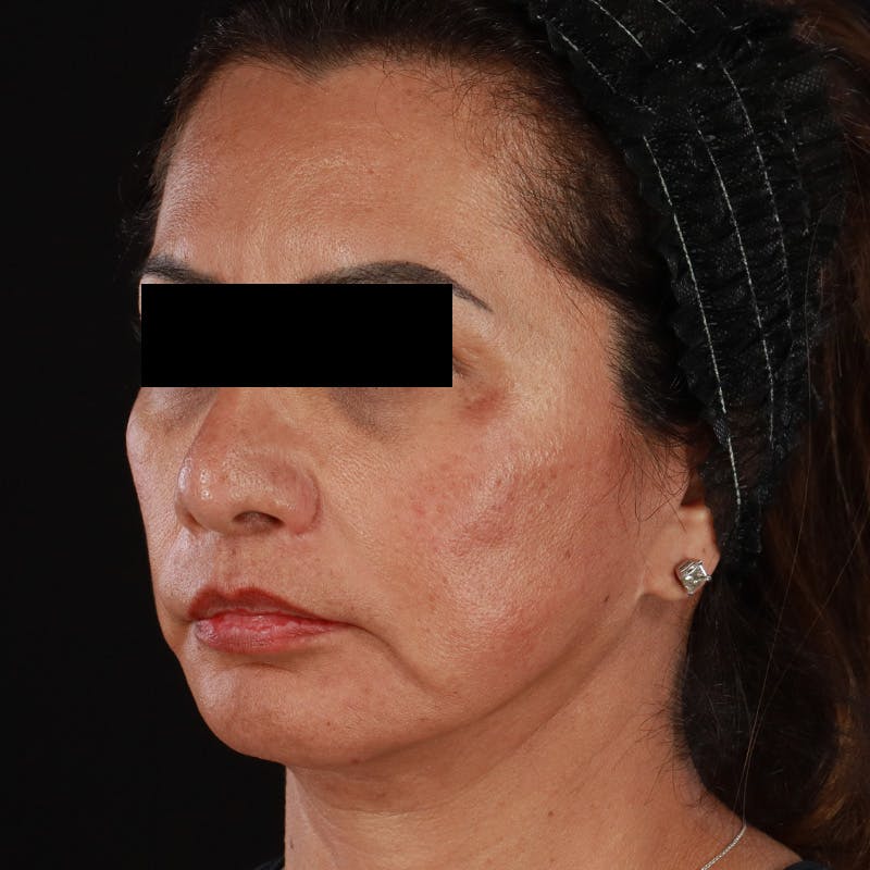 Botox Before & After Gallery - Patient 307630 - Image 12
