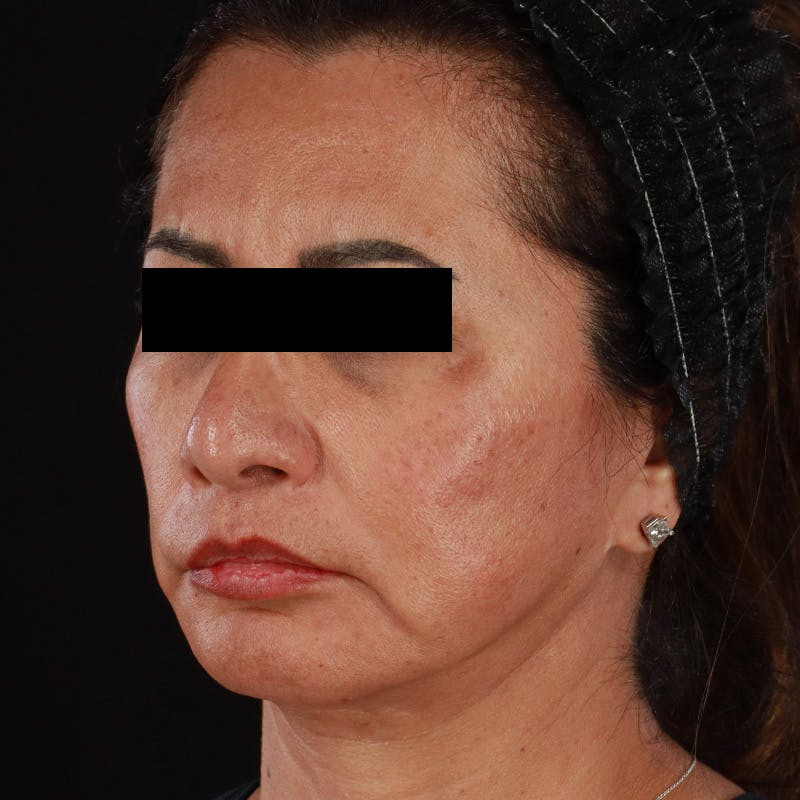 Botox Before & After Gallery - Patient 307630 - Image 14