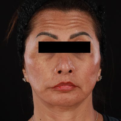 Botox Before & After Gallery - Patient 307630 - Image 2