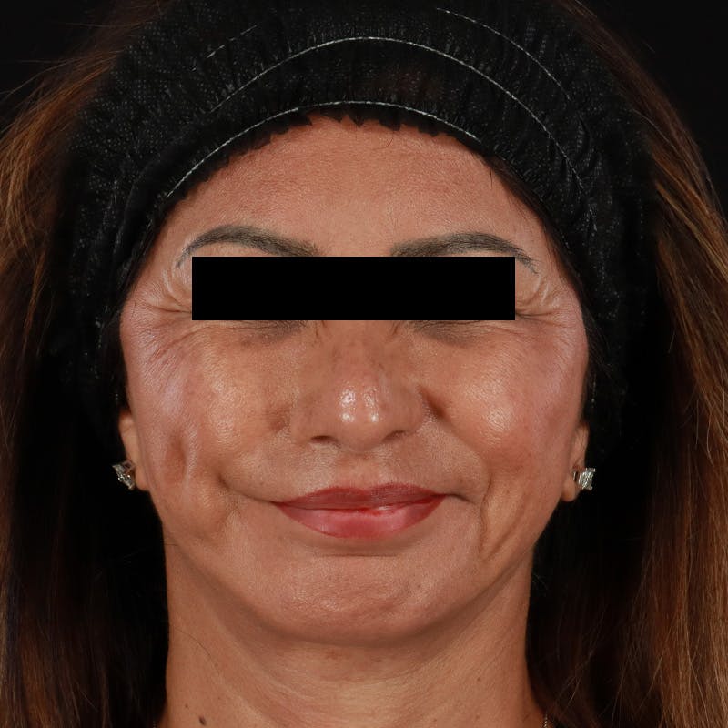 Botox Before & After Gallery - Patient 307630 - Image 3