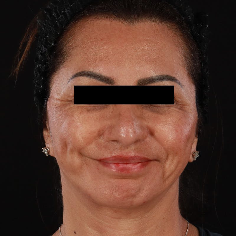 Botox Before & After Gallery - Patient 307630 - Image 4