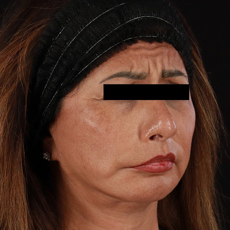 Botox Before & After Gallery - Patient 307630 - Image 9