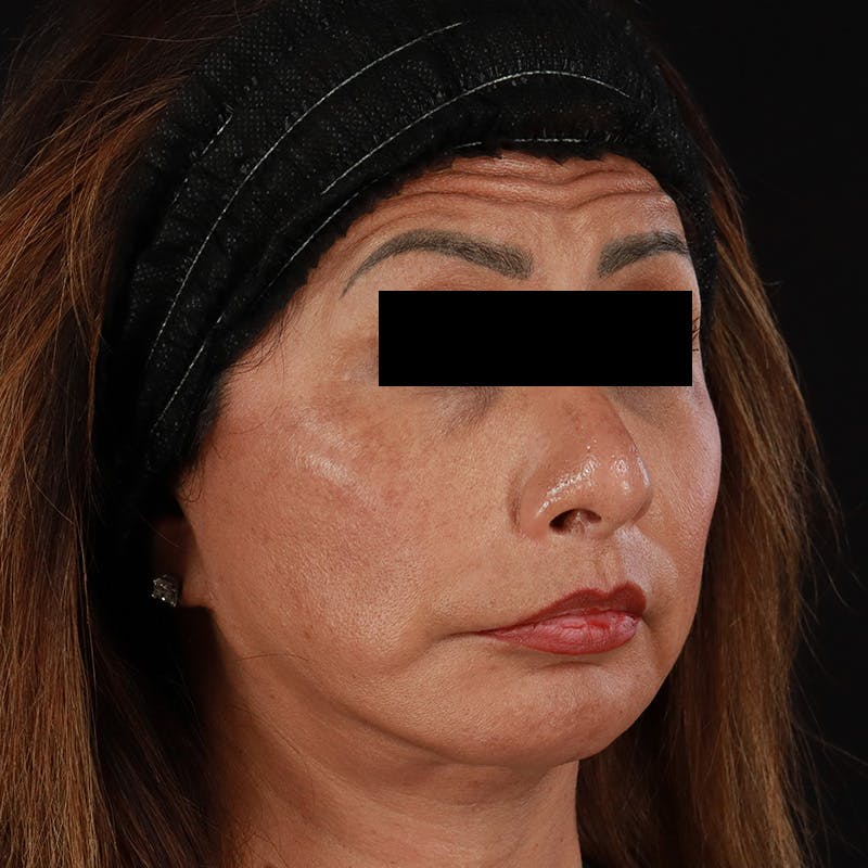 Botox Before & After Gallery - Patient 307630 - Image 7