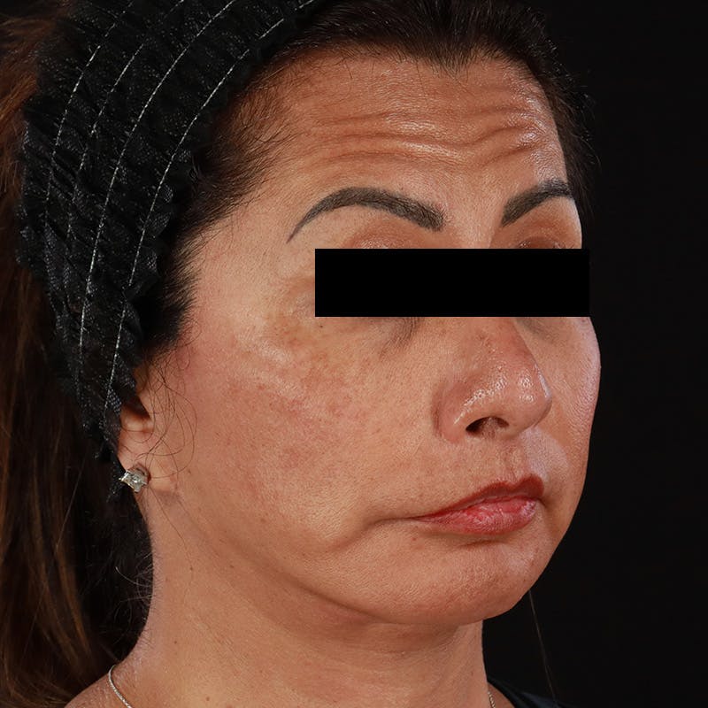 Botox Before & After Gallery - Patient 307630 - Image 8