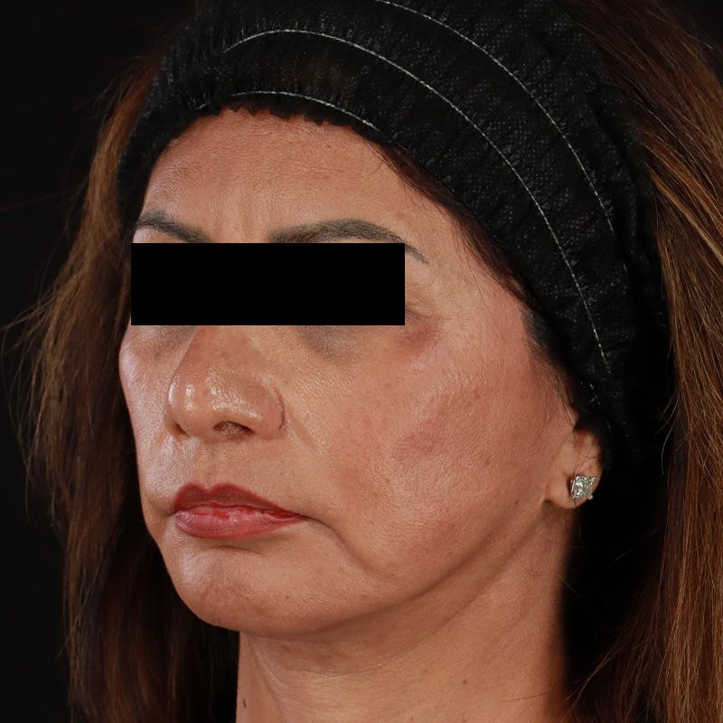 Botox Before & After Gallery - Patient 307630 - Image 11