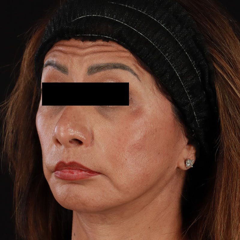 Botox Before & After Gallery - Patient 307630 - Image 15