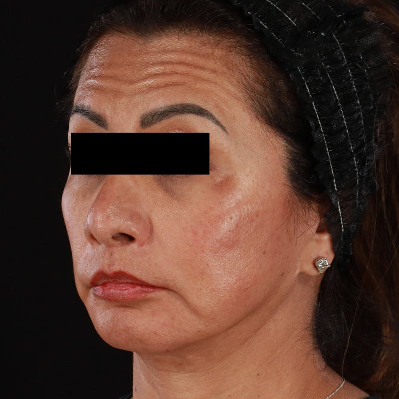 Botox Before & After Gallery - Patient 307630 - Image 16