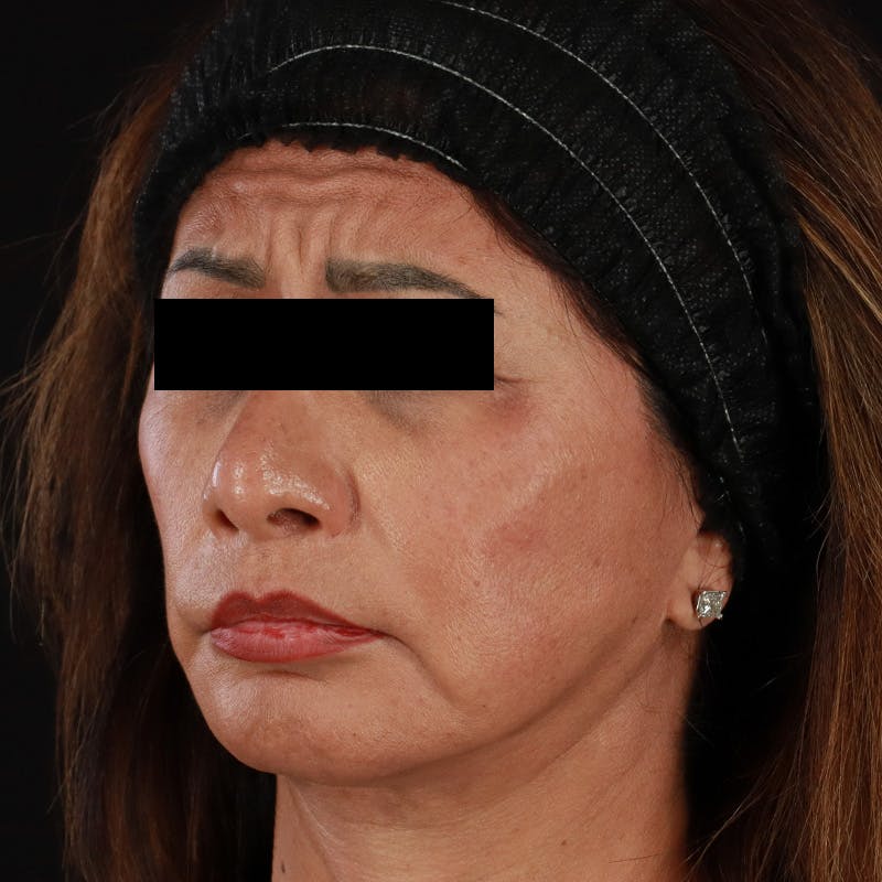 Botox Before & After Gallery - Patient 307630 - Image 13
