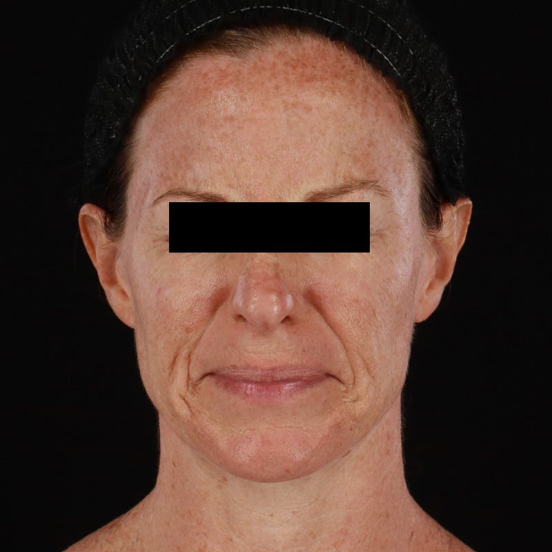 Botox Before & After Gallery - Patient 575049 - Image 4