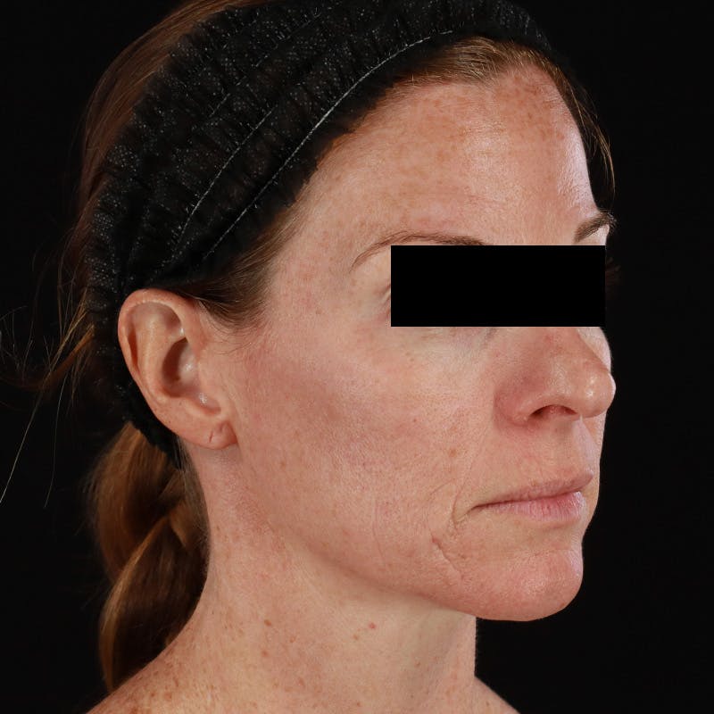 Botox Before & After Gallery - Patient 575049 - Image 5