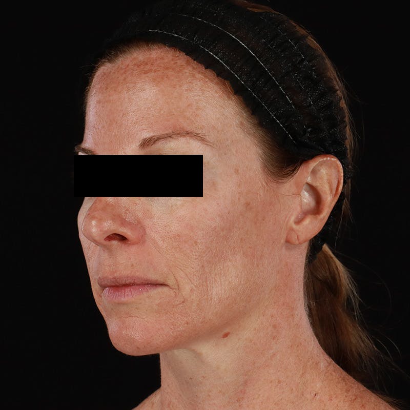 Botox Before & After Gallery - Patient 575049 - Image 16