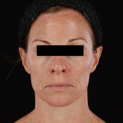 Botox Before & After Gallery - Patient 575049 - Image 1