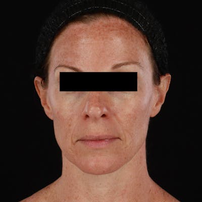 Botox Before & After Gallery - Patient 575049 - Image 2