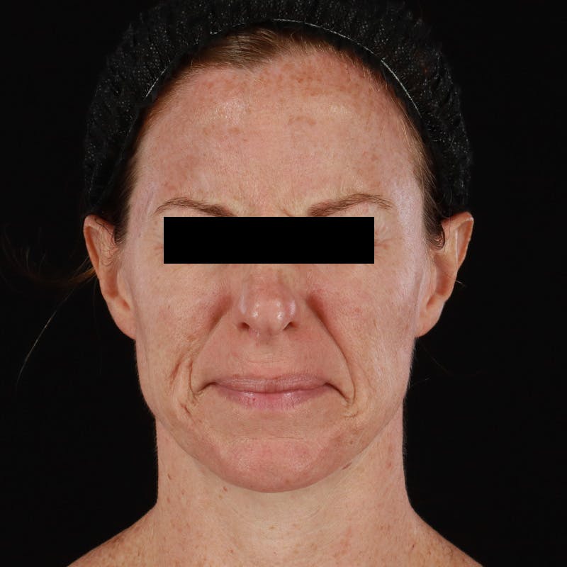 Botox Before & After Gallery - Patient 575049 - Image 3