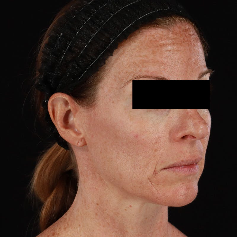 Botox Before & After Gallery - Patient 575049 - Image 6