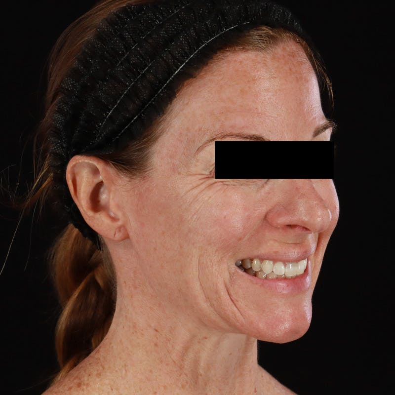 Botox Before & After Gallery - Patient 575049 - Image 7