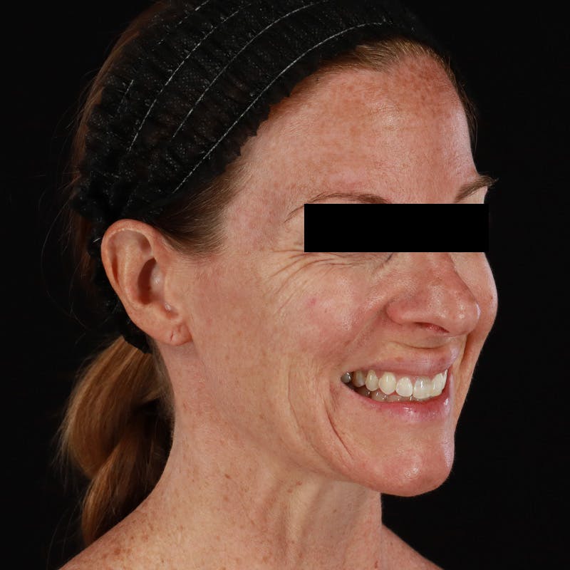 Botox Before & After Gallery - Patient 575049 - Image 8
