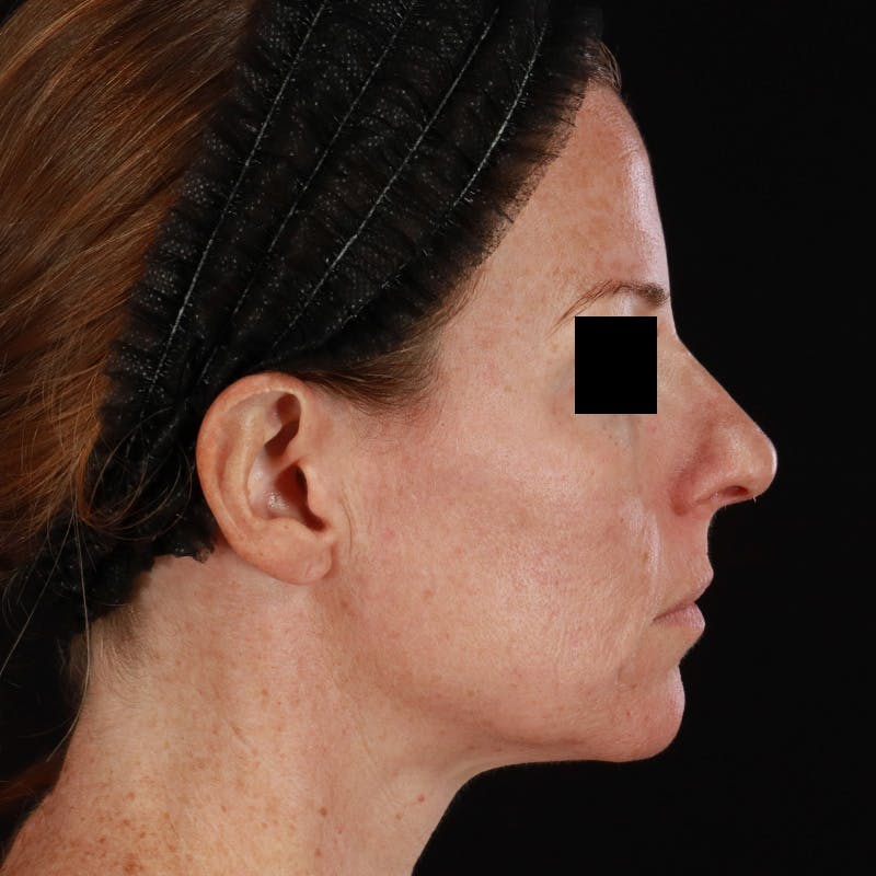Botox Before & After Gallery - Patient 575049 - Image 9