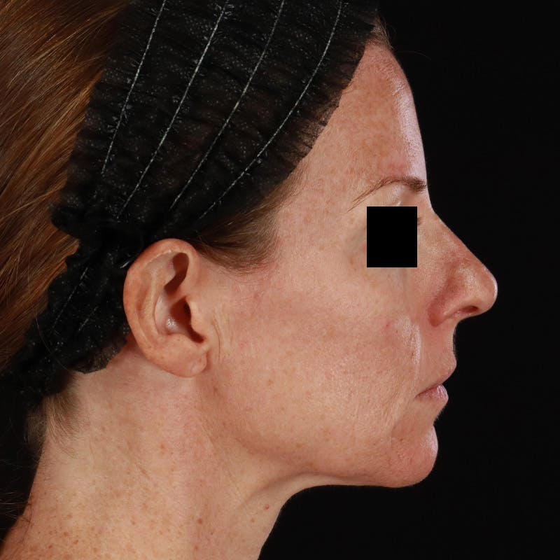Botox Before & After Gallery - Patient 575049 - Image 10