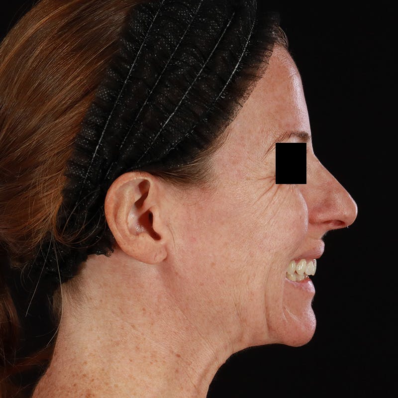Botox Before & After Gallery - Patient 575049 - Image 11
