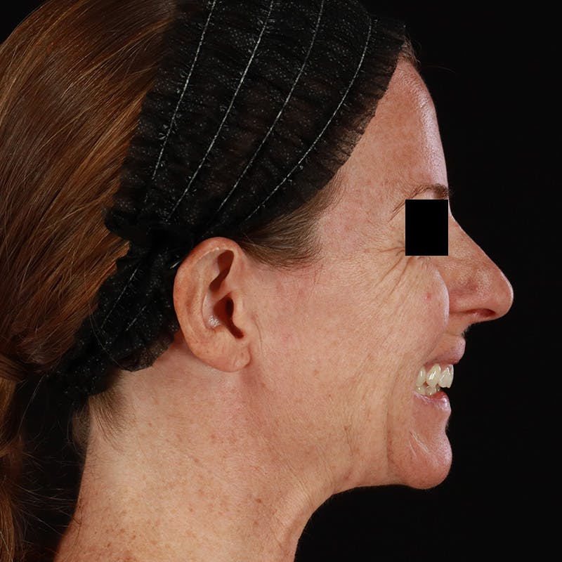 Botox Before & After Gallery - Patient 575049 - Image 12