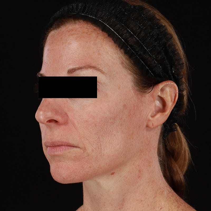 Botox Before & After Gallery - Patient 575049 - Image 15