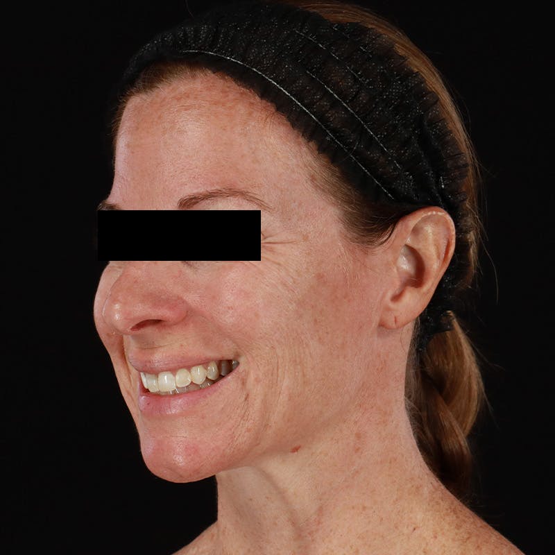Botox Before & After Gallery - Patient 575049 - Image 13