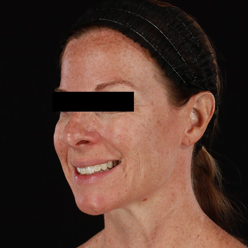 Botox Before & After Gallery - Patient 575049 - Image 14