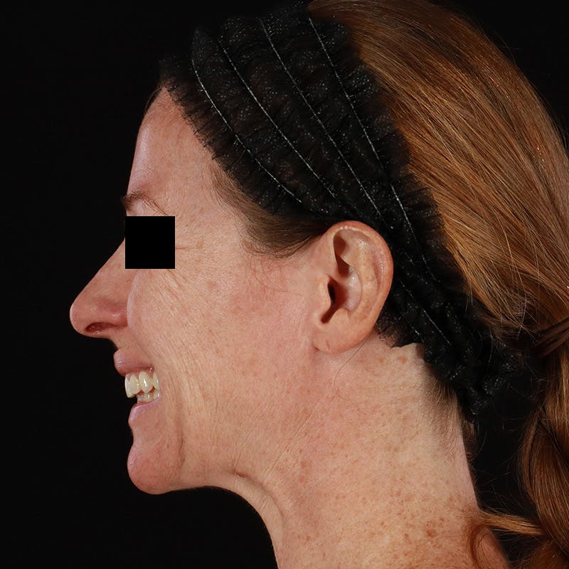Botox Before & After Gallery - Patient 575049 - Image 17