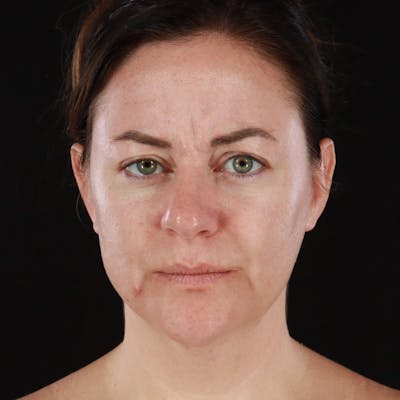 Botox Before & After Gallery - Patient 298673 - Image 1