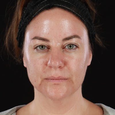 Botox Before & After Gallery - Patient 298673 - Image 2