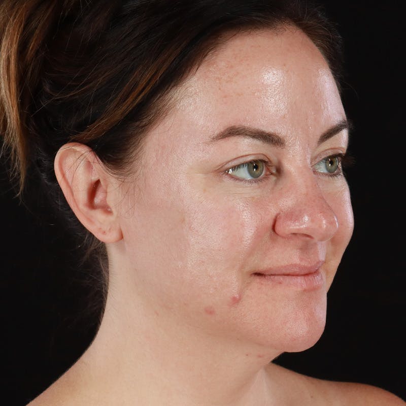 Botox Before & After Gallery - Patient 298673 - Image 3