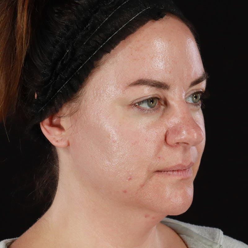 Botox Before & After Gallery - Patient 298673 - Image 4