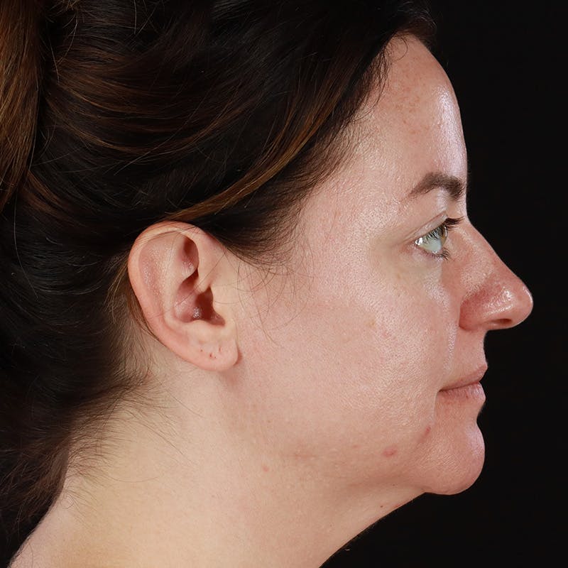 Botox Before & After Gallery - Patient 298673 - Image 5