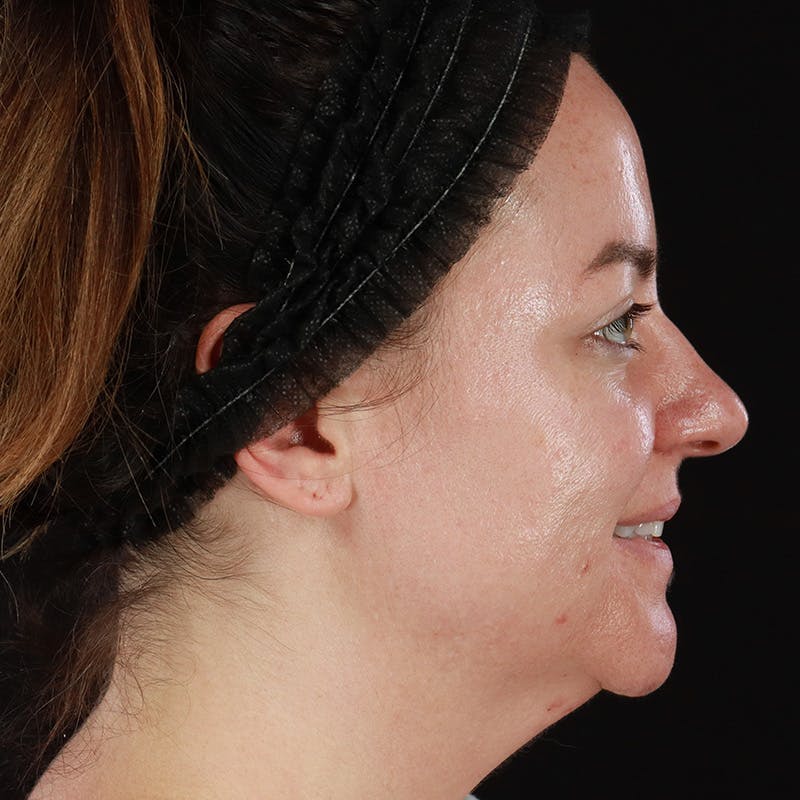 Botox Before & After Gallery - Patient 298673 - Image 6