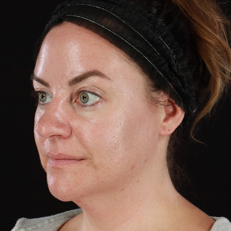 Botox Before & After Gallery - Patient 298673 - Image 8