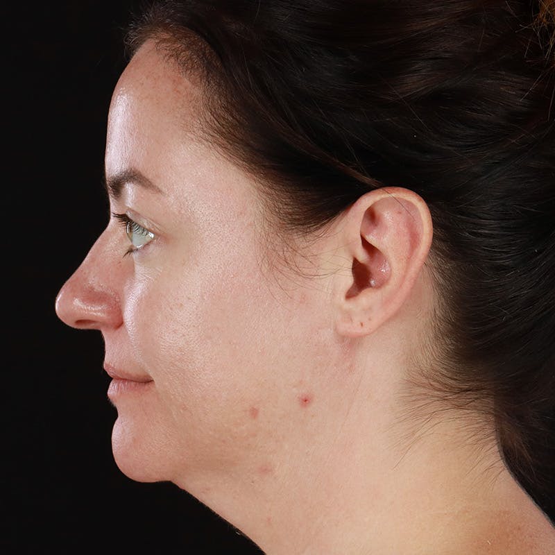 Botox Before & After Gallery - Patient 298673 - Image 9